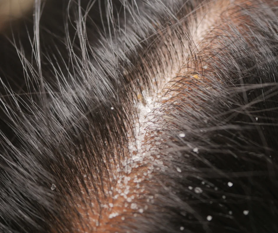 pellicules dans les cheveux